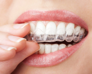 Adult Braces