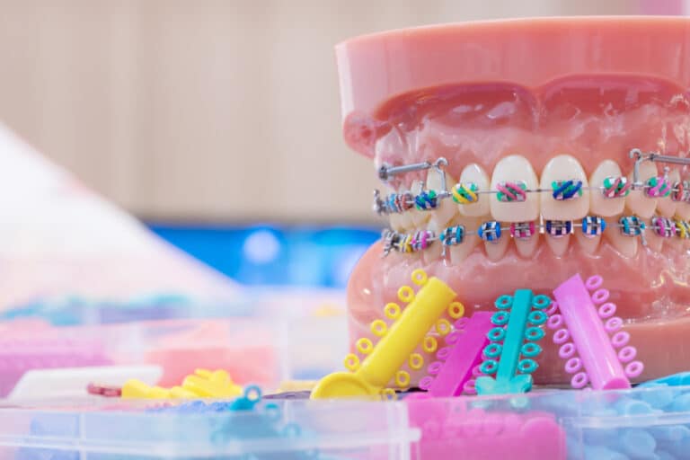 Colorful orthodontic model showing brackets and elastics Basking Ridge and Mendham, NJ - Banasiak & Nettune